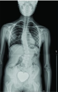 Scoliosis patient with a double curve