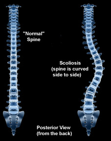 Massage therapy treatments and injury rehab & prevention for scoliosis pain, curved back or spine.  Scoliotic curve treatments from Boulder, Broomfield, Louisville, Westminster, Gunbarrel, Denver massage therapists.