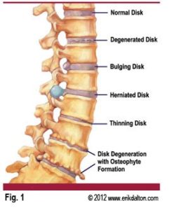 bulging discs and disc herniations