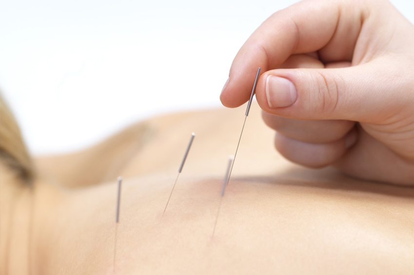 Acupuncture