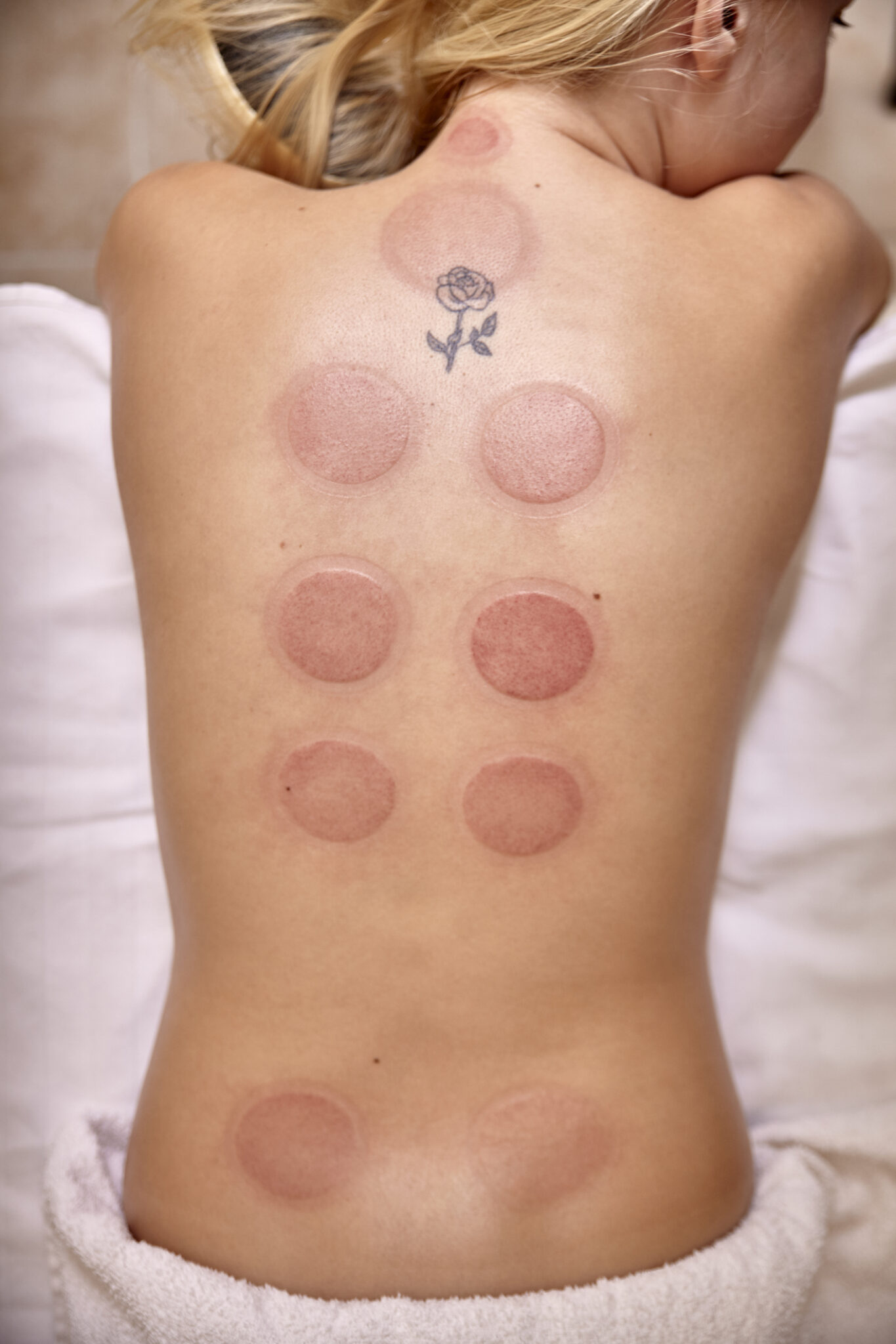 What is Cupping Therapy, How Does it Work and its Benefits. Boulder